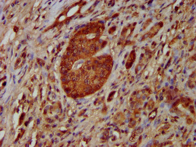 IHC image of NOMO1 Antibody diluted at 1:100 and staining in paraffin-embedded human pancreatic cancer performed on a Leica BondTM system. After dewaxing and hydration, antigen retrieval was mediated by high pressure in a citrate buffer (pH 6.0). Section was blocked with 10% normal goat serum 30min at RT. Then primary antibody (1% BSA) was incubated at 4°C overnight. The primary is detected by a biotinylated secondary antibody and visualized using an HRP conjugated SP system.Rabbit anti-Human NOMO1 Polyclonal Antibody