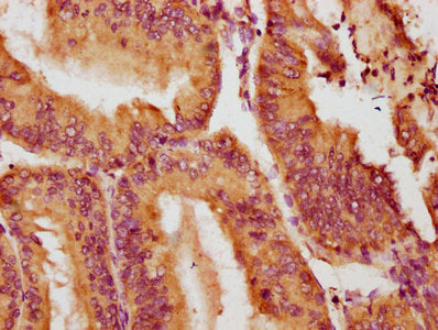 IHC image of NOX1 Antibody diluted at 1:100 and staining in paraffin-embedded human endometrial cancer performed on a Leica BondTM system. After dewaxing and hydration, antigen retrieval was mediated by high pressure in a citrate buffer (pH 6.0). Section was blocked with 10% normal goat serum 30min at RT. Then primary antibody (1% BSA) was incubated at 4°C overnight. The primary is detected by a biotinylated secondary antibody and visualized using an HRP conjugated SP system.Rabbit anti-Human NOX1 Polyclonal Antibody