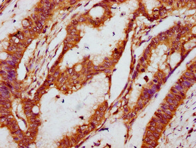 IHC image of NOX1 Antibody diluted at 1:100 and staining in paraffin-embedded human colon cancer performed on a Leica BondTM system. After dewaxing and hydration, antigen retrieval was mediated by high pressure in a citrate buffer (pH 6.0). Section was blocked with 10% normal goat serum 30min at RT. Then primary antibody (1% BSA) was incubated at 4°C overnight. The primary is detected by a biotinylated secondary antibody and visualized using an HRP conjugated SP system.Rabbit anti-Human NOX1 Polyclonal Antibody