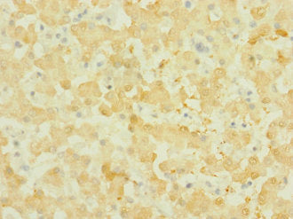 Immunohistochemistry of paraffin-embedded human liver tissue using NOX3 Antibody at dilution of 1:100Rabbit anti-Human NOX3 Polyclonal Antibody
