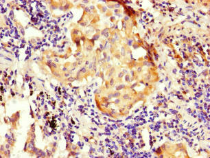 Immunohistochemistry of paraffin-embedded human lung cancer using NOXA1 Antibody at dilution of 1:100Rabbit anti-Human NOXA1 Polyclonal Antibody