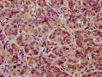 IHC image of the antibody diluted at 1:200 and staining in paraffin-embedded human liver cancer performed on a Leica BondTM system. After dewaxing and hydration, antigen retrieval was mediated by high pressure in a citrate buffer (pH 6.0). Section was blocked with 10% normal goat serum 30min at RT. Then primary antibody (1% BSA) was incubated at 4°C overnight. The primary is detected by a biotinylated secondary antibody and visualized using an HRP conjugated SP system.Rabbit anti-Human NOXO1 Polyclonal Antibody