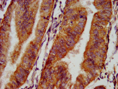 IHC image of the antibody diluted at 1:500 and staining in paraffin-embedded human endometrial cancer performed on a Leica BondTM system. After dewaxing and hydration, antigen retrieval was mediated by high pressure in a citrate buffer (pH 6.0). Section was blocked with 10% normal goat serum 30min at RT. Then primary antibody (1% BSA) was incubated at 4°C overnight. The primary is detected by a biotinylated secondary antibody and visualized using an HRP conjugated SP system.