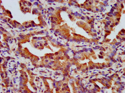 IHC image of NPHP4 Antibody diluted at 1:500 and staining in paraffin-embedded human lung cancer performed on a Leica BondTM system. After dewaxing and hydration, antigen retrieval was mediated by high pressure in a citrate buffer (pH 6.0). Section was blocked with 10% normal goat serum 30min at RT. Then primary antibody (1% BSA) was incubated at 4°C overnight. The primary is detected by a biotinylated secondary antibody and visualized using an HRP conjugated SP system.