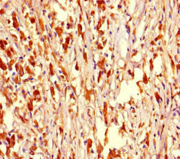 Immunohistochemistry of paraffin-embedded human melanoma using the antibody at dilution of 1:100Rabbit anti-Human NR1H2 Polyclonal Antibody