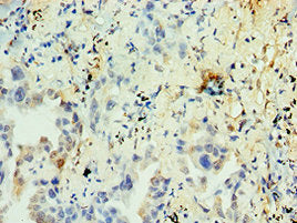 Immunohistochemistry of paraffin-embedded human lung cancer using NR2C2 Antibody at dilution of 1:100Rabbit anti-Human NR2C2 Polyclonal Antibody