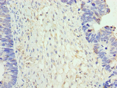 Immunohistochemistry of paraffin-embedded human ovarian cancer using NR2C2AP Antibody at dilution of 1:100Rabbit anti-Human NR2C2AP Polyclonal Antibody