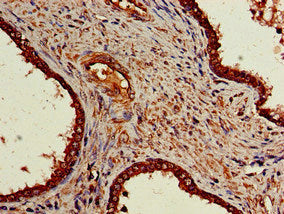 Immunohistochemistry of paraffin-embedded human prostate cancer using NR5A2 Antibody at dilution of 1:100Rabbit anti-Human NR5A2 Polyclonal Antibody