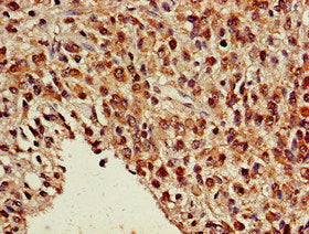 Immunohistochemistry of paraffin-embedded human glioma using NR5A2 Antibody at dilution of 1:100Rabbit anti-Human NR5A2 Polyclonal Antibody