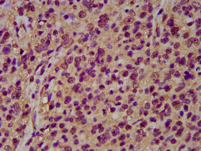 IHC image of the antibody diluted at 1:200 and staining in paraffin-embedded human glioma performed on a Leica BondTM system. After dewaxing and hydration, antigen retrieval was mediated by high pressure in a citrate buffer (pH 6.0). Section was blocked with 10% normal goat serum 30min at RT. Then primary antibody (1% BSA) was incubated at 4°C overnight. The primary is detected by a biotinylated secondary antibody and visualized using an HRP conjugated SP system.Rabbit anti-Human NRCAM Polyclonal Antibody