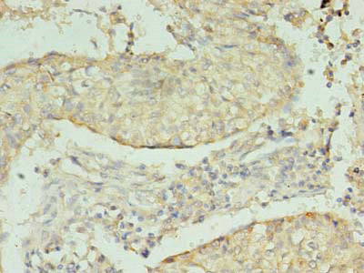 Immunohistochemistry of paraffin-embedded human lung cancer using NRG2 Antibody at dilution of 1:100Rabbit anti-Human NRG2 Polyclonal Antibody
