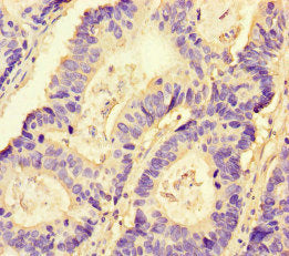 Immunohistochemistry of paraffin-embedded human colon cancer using the antibody at dilution of 1:100Rabbit anti-Human NRP2 Polyclonal Antibody
