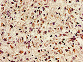 Immunohistochemistry of paraffin-embedded human glioma using NTHL1 Antibody at dilution of 1:100Rabbit anti-Human NTHL1 Polyclonal Antibody