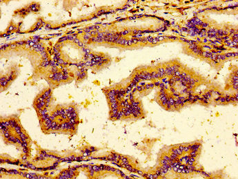 Immunohistochemistry of paraffin-embedded human prostate tissue using NTSR2 Antibody at dilution of 1:100Rabbit anti-Human NTSR2 Polyclonal Antibody