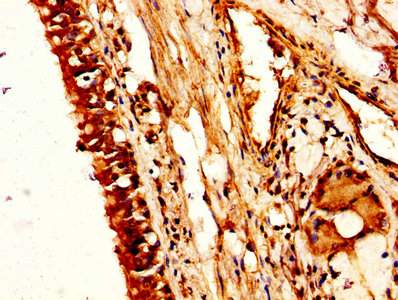 IHC image of NUCB2 Antibody diluted at 1:200 and staining in paraffin-embedded human lung cancer performed on a Leica BondTM system. After dewaxing and hydration, antigen retrieval was mediated by high pressure in a citrate buffer (pH 6.0). Section was blocked with 10% normal goat serum 30min at RT. Then primary antibody (1% BSA) was incubated at 4°C overnight. The primary is detected by a biotinylated secondary antibody and visualized using an HRP conjugated SP system.Rabbit anti-Human NUCB2 Polyclonal Antibody