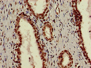 Immunohistochemistry of paraffin-embedded human prostate cancer using XRCC6 Antibody at dilution of 1:100Rabbit anti-Human XRCC6 Polyclonal Antibody