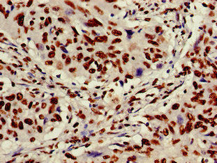 Immunohistochemistry of paraffin-embedded human lung cancer using XRCC6 Antibody at dilution of 1:100Rabbit anti-Human XRCC6 Polyclonal Antibody