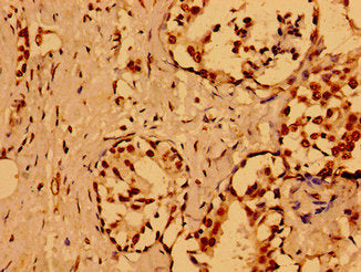 Immunohistochemistry of paraffin-embedded human breast cancer using NUMA1 Antibody at dilution of 1:100Rabbit anti-Human NUMA1 Polyclonal Antibody