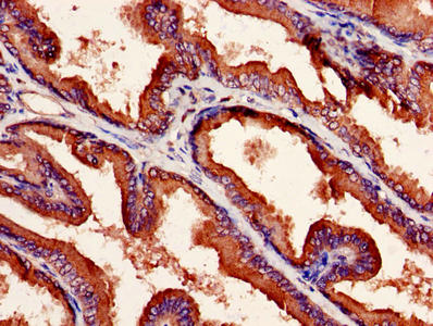 Immunohistochemistry of paraffin-embedded human prostate cancer using NXF5 Antibody at dilution of 1:100Rabbit anti-Human NXF5 Polyclonal Antibody