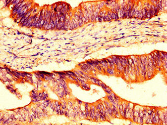 IHC image of OCLN Antibody diluted at 1:400 and staining in paraffin-embedded human colon cancer performed on a Leica BondTM system. After dewaxing and hydration, antigen retrieval was mediated by high pressure in a citrate buffer (pH 6.0). Section was blocked with 10% normal goat serum 30min at RT. Then primary antibody (1% BSA) was incubated at 4°C overnight. The primary is detected by a biotinylated secondary antibody and visualized using an HRP conjugated SP system.Rabbit anti-Human OCLN Polyclonal Antibody