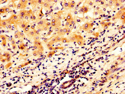 IHC image of OGN Antibody diluted at 1:300 and staining in paraffin-embedded human liver cancer performed on a Leica BondTM system. After dewaxing and hydration, antigen retrieval was mediated by high pressure in a citrate buffer (pH 6.0). Section was blocked with 10% normal goat serum 30min at RT. Then primary antibody (1% BSA) was incubated at 4°C overnight. The primary is detected by a biotinylated secondary antibody and visualized using an HRP conjugated SP system.Rabbit anti-Human OGN Polyclonal Antibody
