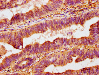 IHC image of OMD Antibody diluted at 1:400 and staining in paraffin-embedded human colon cancer performed on a Leica BondTM system. After dewaxing and hydration, antigen retrieval was mediated by high pressure in a citrate buffer (pH 6.0). Section was blocked with 10% normal goat serum 30min at RT. Then primary antibody (1% BSA) was incubated at 4°C overnight. The primary is detected by a biotinylated secondary antibody and visualized using an HRP conjugated SP system.Rabbit anti-Human OMD Polyclonal Antibody