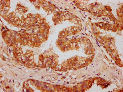 IHC image of OMD Antibody diluted at 1:400 and staining in paraffin-embedded human prostate cancer performed on a Leica BondTM system. After dewaxing and hydration, antigen retrieval was mediated by high pressure in a citrate buffer (pH 6.0). Section was blocked with 10% normal goat serum 30min at RT. Then primary antibody (1% BSA) was incubated at 4°C overnight. The primary is detected by a biotinylated secondary antibody and visualized using an HRP conjugated SP system.Rabbit anti-Human OMD Polyclonal Antibody