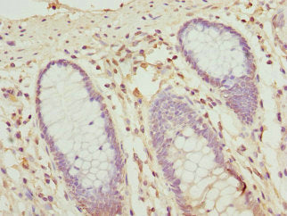 Immunohistochemistry of paraffin-embedded human colon cancer using OPHN1 Antibody at dilution of 1:100Rabbit anti-Human OPHN1 Polyclonal Antibody