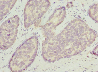 Immunohistochemistry of paraffin-embedded human gastric cancer using OPHN1 Antibody at dilution of 1:100Rabbit anti-Human OPHN1 Polyclonal Antibody