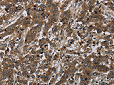 The image on the left is immunohistochemistry of paraffin-embedded Human liver cancer tissue using LAIR2 Antibody(LAIR2 Antibody) at dilution 1/20, on the right is treated with synthetic peptide. (Original magnification: ×200)