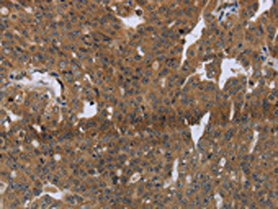 The image on the left is immunohistochemistry of paraffin-embedded Human ovarian cancer tissue using the antibody Antibody) at dilution 1/20, on the right is treated with synthetic peptide. (Original magnification: ×200)