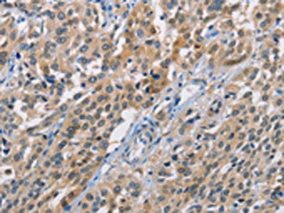 The image on the left is immunohistochemistry of paraffin-embedded Human esophagus cancer tissue using CBR1 Antibody(CBR1 Antibody) at dilution 1/40, on the right is treated with fusion protein. (Original magnification: ×200)