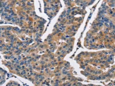 The image on the left is immunohistochemistry of paraffin-embedded Human breast cancer tissue using the antibody Antibody) at dilution 1/40, on the right is treated with fusion protein. (Original magnification: ×200)