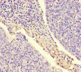 Immunohistochemistry of paraffin-embedded human cervical cancer using the antibody at dilution of 1:100Rabbit anti-Human ARAF Polyclonal Antibody