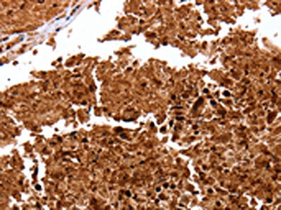 The image on the left is immunohistochemistry of paraffin-embedded Human lung cancer tissue using CLEC4A Antibody(CLEC4A Antibody) at dilution 1/15, on the right is treated with fusion protein. (Original magnification: ×200)Rabbit anti-Human CLEC4A Polyclonal Antibody
