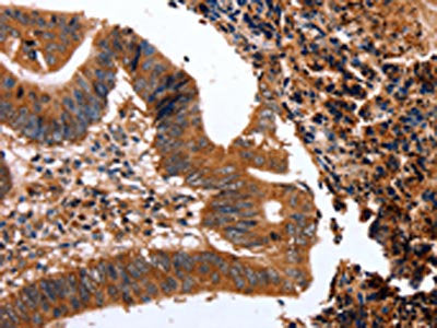 The image on the left is immunohistochemistry of paraffin-embedded Human colon cancer tissue using the antibody Antibody) at dilution 1/15, on the right is treated with fusion protein. (Original magnification: ×200)Rabbit anti-Human CLEC4A Polyclonal Antibody