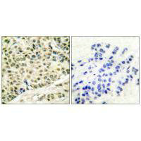 Immunohistochemical analysis of paraffin-embedded human breast carcinoma tissue using MCM2 antibody.