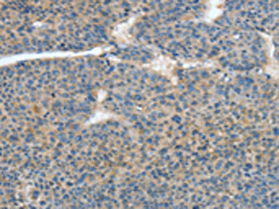 The image on the left is immunohistochemistry of paraffin-embedded Human liver cancer tissue using the antibody Antibody) at dilution 1/40, on the right is treated with fusion protein. (Original magnification: ×200)
