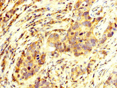 IHC image of OTX2 Antibody diluted at 1:250 and staining in paraffin-embedded human pancreatic cancer performed on a Leica BondTM system. After dewaxing and hydration, antigen retrieval was mediated by high pressure in a citrate buffer (pH 6.0). Section was blocked with 10% normal goat serum 30min at RT. Then primary antibody (1% BSA) was incubated at 4°C overnight. The primary is detected by a biotinylated secondary antibody and visualized using an HRP conjugated SP system.Rabbit anti-Human OTX2 Polyclonal Antibody