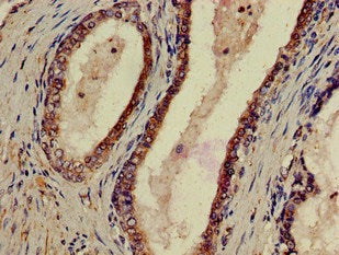 Immunohistochemistry of paraffin-embedded human prostate cancer using the antibody at dilution of 1:100Rabbit anti-Human P2RX1 Polyclonal Antibody
