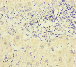 Immunohistochemistry of paraffin-embedded human liver cancer using P2RX3 Antibody at dilution of 1:100Rabbit anti-Human P2RX3 Polyclonal Antibody