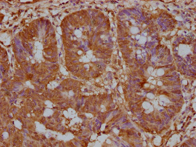 IHC image of LPAR6 Antibody diluted at 1:200 and staining in paraffin-embedded human colon cancer performed on a Leica BondTM system. After dewaxing and hydration, antigen retrieval was mediated by high pressure in a citrate buffer (pH 6.0). Section was blocked with 10% normal goat serum 30min at RT. Then primary antibody (1% BSA) was incubated at 4°C overnight. The primary is detected by a biotinylated secondary antibody and visualized using an HRP conjugated SP system.