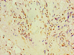 Immunohistochemistry of paraffin-embedded human breast cancer using P4HA2 Antibody at dilution of 1:100Rabbit anti-Human P4HA2 Polyclonal Antibody