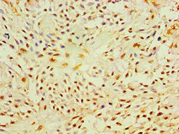 Immunohistochemistry of paraffin-embedded human breast cancer using the antibody at dilution of 1:100Rabbit anti-Human P4HA2 Polyclonal Antibody