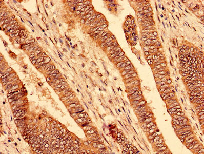 Immunohistochemistry analysis of human colon cancer using PAFAH1B2 Antibody at dilution of 1:100Rabbit anti-Human PAFAH1B2 Polyclonal Antibody