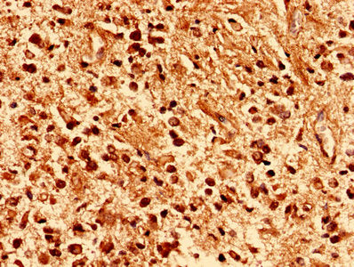 Immunohistochemistry analysis of human glioma using PAFAH1B2 Antibody at dilution of 1:100Rabbit anti-Human PAFAH1B2 Polyclonal Antibody