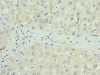 Immunohistochemistry of paraffin-embedded human liver tissue using PAICS Antibody at dilution of 1:100Rabbit anti-Human PAICS Polyclonal Antibody