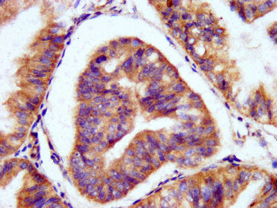 IHC image of PAM Antibody diluted at 1:200 and staining in paraffin-embedded human endometrial cancer performed on a Leica BondTM system. After dewaxing and hydration, antigen retrieval was mediated by high pressure in a citrate buffer (pH 6.0). Section was blocked with 10% normal goat serum 30min at RT. Then primary antibody (1% BSA) was incubated at 4°C overnight. The primary is detected by a biotinylated secondary antibody and visualized using an HRP conjugated SP system.Rabbit anti-Human PAM Polyclonal Antibody