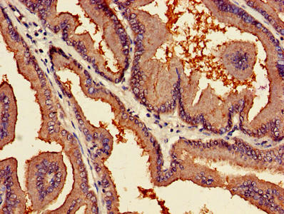Immunohistochemistry of paraffin-embedded human prostate cancer using PARN Antibody at dilution of 1:100