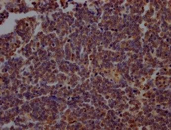 IHC image of PARP1 Antibody diluted at 1:200 and staining in paraffin-embedded human lung cancer performed on a Leica BondTM system. After dewaxing and hydration, antigen retrieval was mediated by high pressure in a citrate buffer (pH 6.0). Section was blocked with 10% normal goat serum 30min at RT. Then primary antibody (1% BSA) was incubated at 4°C overnight. The primary is detected by a Goat anti-rabbit polymer IgG labeled by HRP and visualized using 0.05% DAB.Rabbit anti-Human PARP1 Polyclonal Antibody
